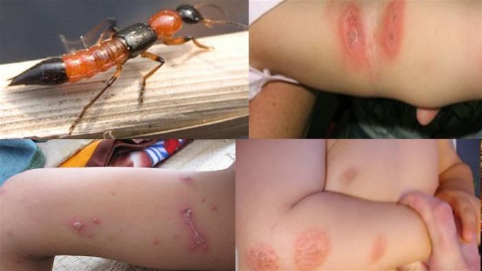 Kiến ba khoang và vết bỏng da trên trẻ em do tiếp xúc chất pederin